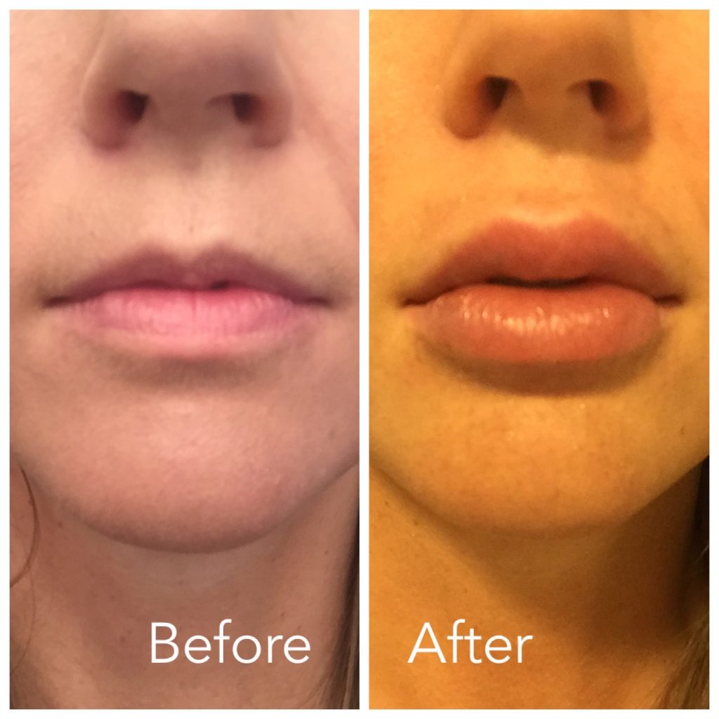 candy lipz before/after