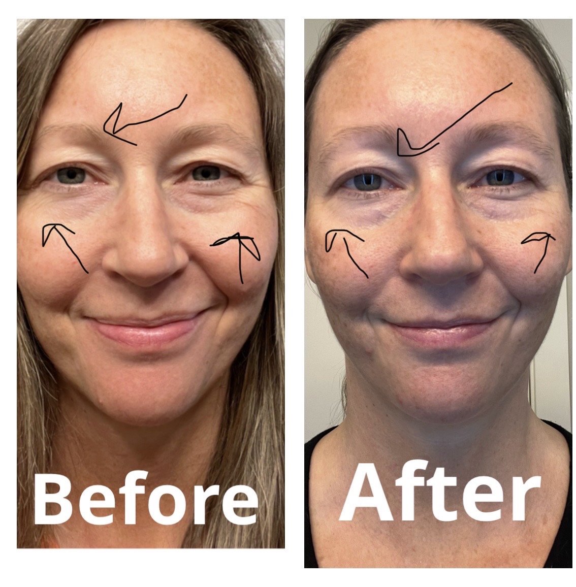 NIRA PRO at home AntiAging Laser Review I Saw Significant Results in